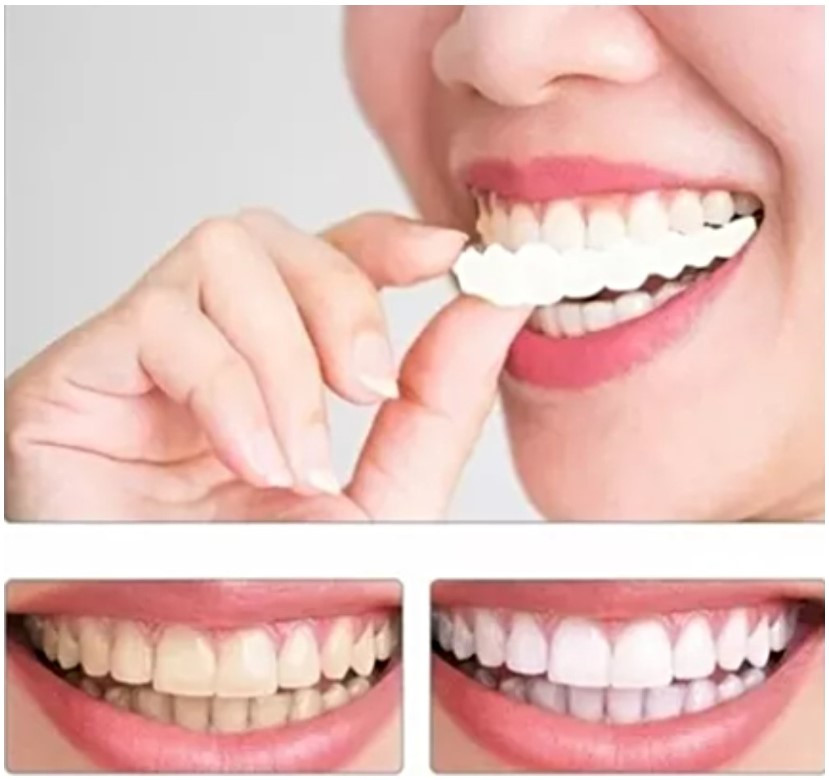 CARILLAS DENTALES - Imagen 2