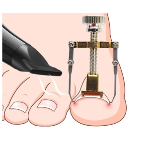 Corrector Uñas Encarnadas Uñero